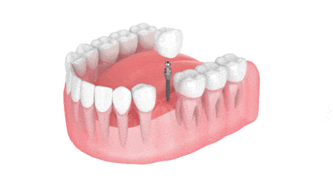 Implantes Dentales en Gulfport, MS