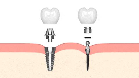 Mini Implantes Dentales en Gulfport, MS