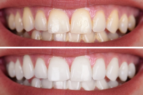 Teeth Whitening in Gulfport, MS