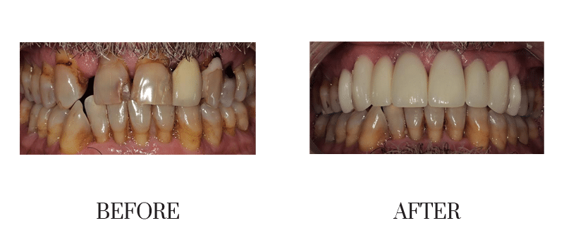 Bridge, crowns, decay, discolored, male, middle-aged, missing, old fillings, smile makeover