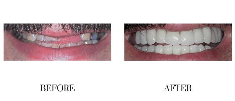 Broken, chipped, crowns, male, middle-aged, smile makeover, worn