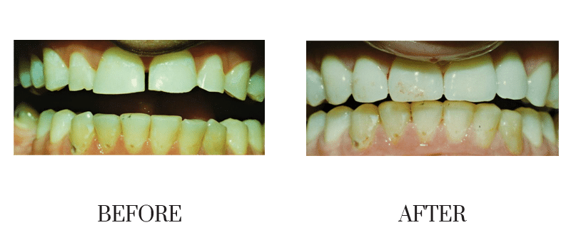 Chipped, crowns, male, middle-aged, shape, smile makeover, worn