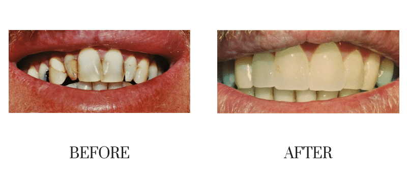 Crowns, decay, discolored, male, middle-aged, smile makeover