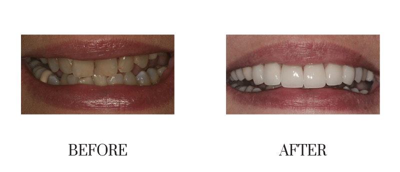 Crowns, discolored, female, jumbled, middle-aged, smile makeover