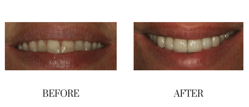 Crowns, discolored, female, middle-aged, smile makeover 02