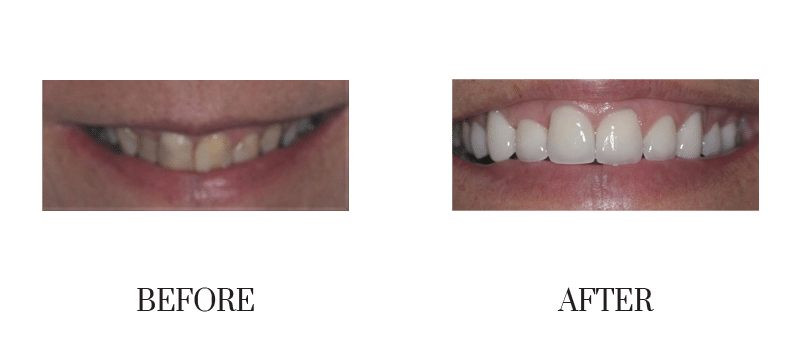 Crowns, discolored, female, middle-aged, smile makeover 03