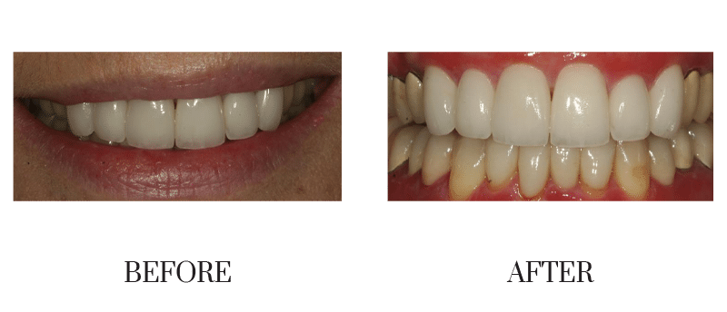 Crowns, discolored, female, middle-aged, smile makeover