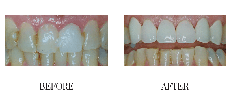 Crowns, discolored, jumbled, male, old crowns, older, shape, smile makeover, younger