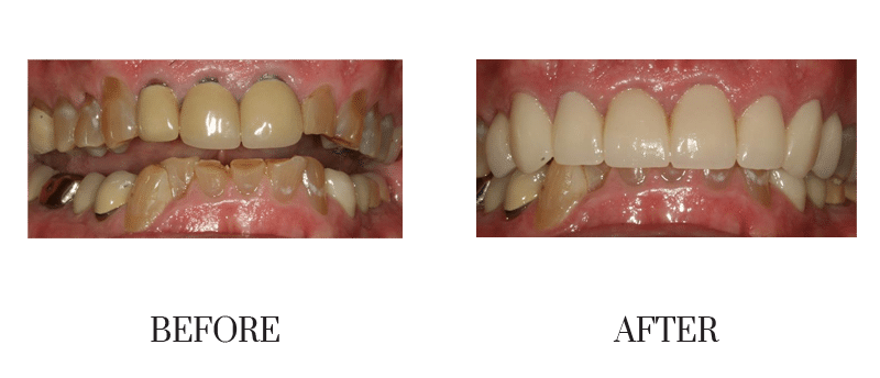 Crowns, discolored, male, middle-aged, old crowns, smile makeover, worn