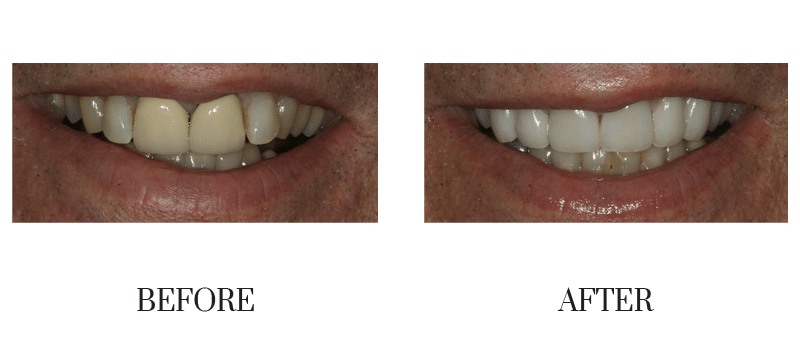 Crowns, discolored, male, middle-aged, old crowns, smile makeover