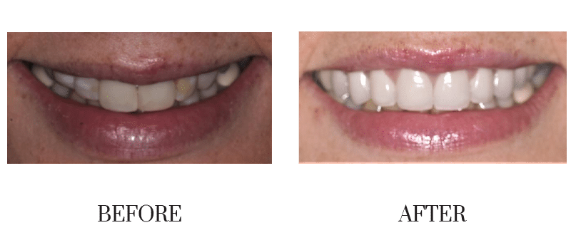 Crowns, events, female, middle-aged, old crowns, smile makeover