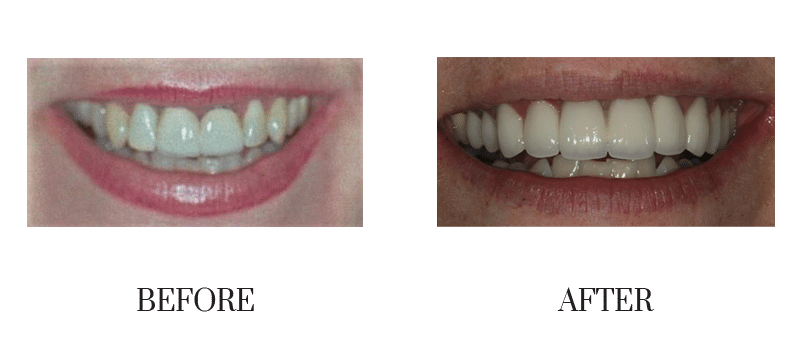 Crowns, female, middle-aged, old crowns, smile makeover 02