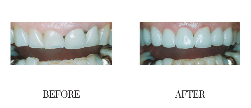 Crowns, female, middle-aged, old crowns, smile makeover