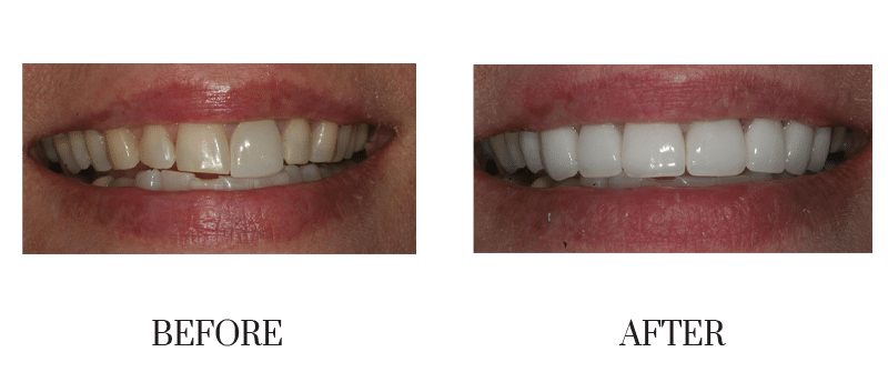 Crowns, female, middle-aged, shape, smile makeover, worn