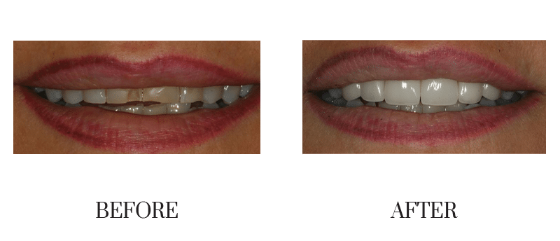 Crowns, female, middle-aged, smile makeover, worn