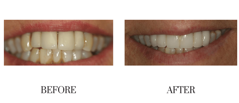 Crowns, female, old crowns, smile makeover, younger