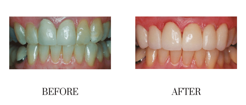 Crowns, female, old crowns, smile makeover