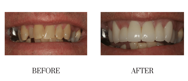 Crowns, jumbled, male, middle-aged, smile makeover