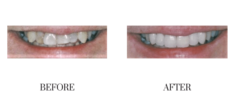 Crowns, jumbled, male, shape, smile makeover, younger