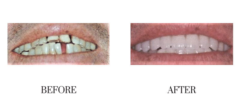 Crowns, jumbled, male, smile makeover, younger
