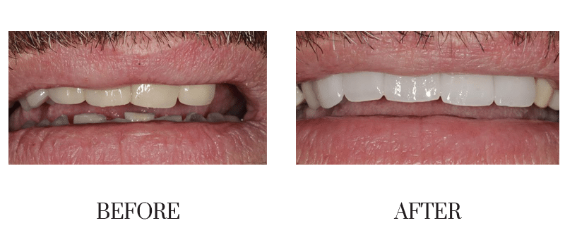 Crowns, male, smile makeover, younger