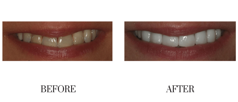 DIscolored, female, smile makeover, veneer, younger