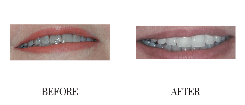 Discolored, female, middle-aged, smile makeover, tetracycline, veneer