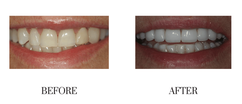 Discolored, female, middle-aged, smile makeover, veneer