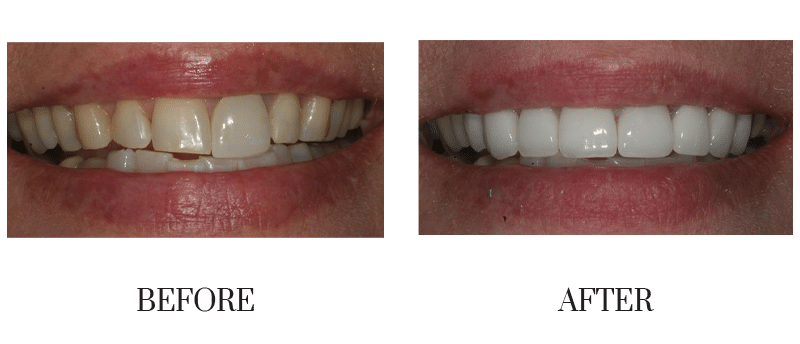Discolored, teeth whitening, female, middle-aged