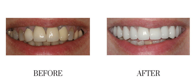 Female, middle-aged, old crowns, smile makeover