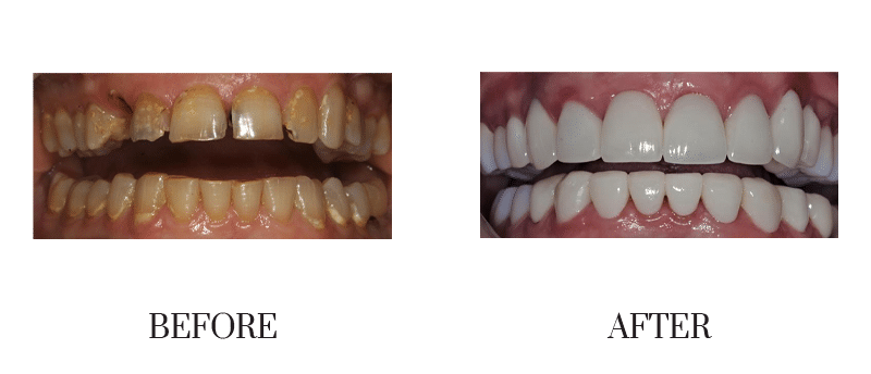 Bridge, chipped, crowns, decay, discolored, female, middle-aged, missing, smile makeover