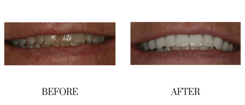 Crowns, female, jumbled, middle-aged, smile makeover