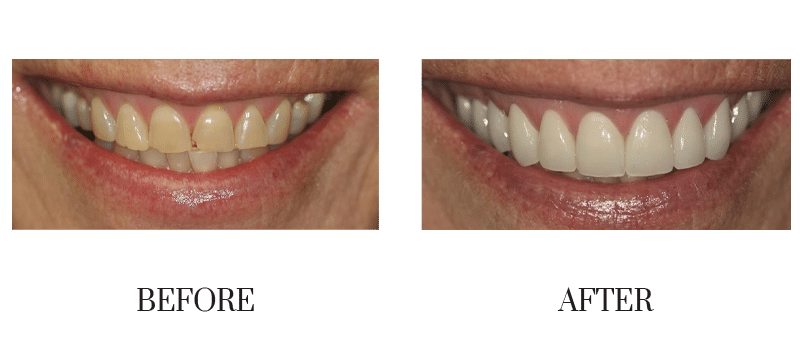 Discolored, female, middle-aged, smile makeover, veneer, worn