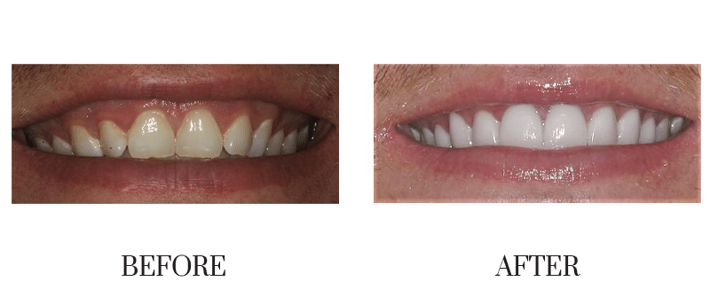Jumbled, male, smile makeover, veneer, young