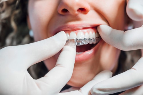 Orthodontic Treatment in Gulfport, MS