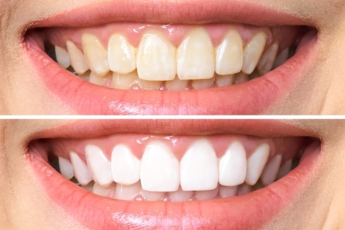 Blanqueamiento dental en Gulfport, MS - Dr. John Hopkins DDS