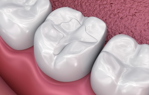 Tooth Colored Fillings in Gulfport, MS - Dr. John Hopkins DDS