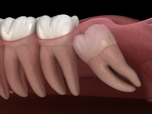 Wisdom Tooth Extraction in Gulfport, MS - John Hopkins, DDS