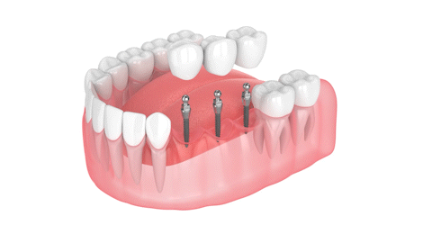 What is a Dental Bridge John Hopkins DDS Gulfport, MS
