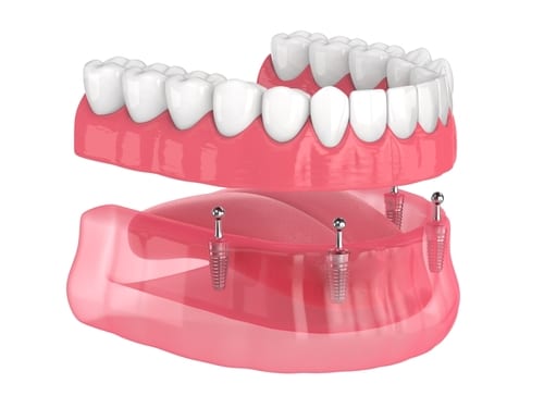 Mini Implant Dentures | Gulfport, MS | Dr. John Hopkins