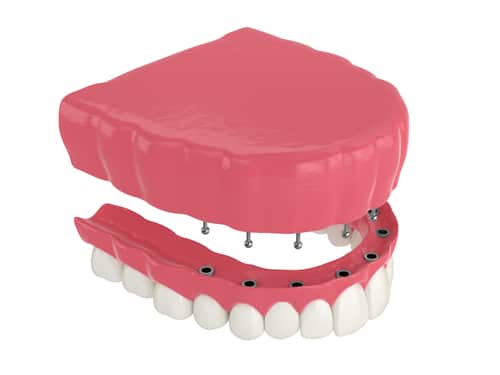 Snap-In Dentures An Alternative to Traditional Dentures Gulfport