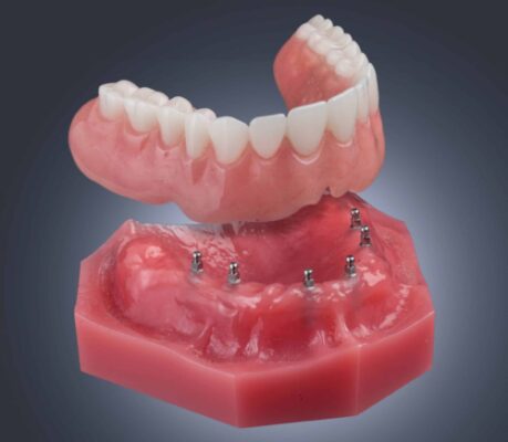 Mini Dentaduras en Gulfport, MS | Mini Implantes | Estabilización de Dentaduras