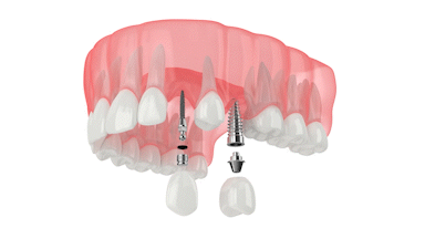 Mini Implants Cost in Gulfport, MS | Implant Dentistry | New Teeth