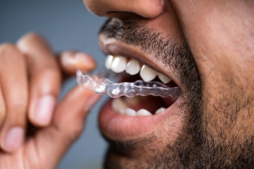 Clear Aligners In Gulfport, MS | Cosmetic Dentistry | Invisalign