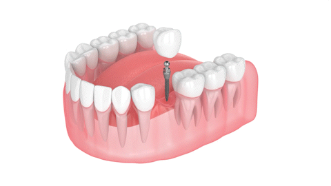 Same-Day Dental Implants in Gulfport, MS | Mini Dental Implants