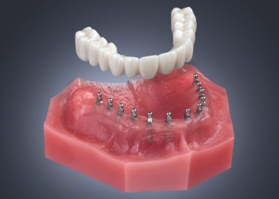 Dentaduras Flojas en Gulfport, MS | Mini Implantes | Dentaduras Implantadas