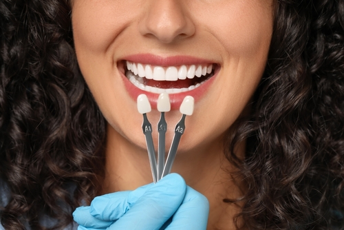 Permanent Teeth Whitening in Gulfport, MS | Porcelain Veneers