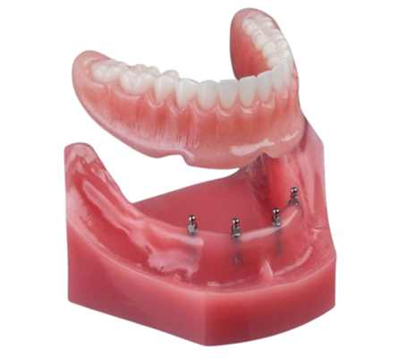 Mini Implant Dentures in Gulfport, MS | Reserve una consulta gratuita