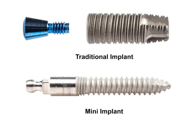 Mini Implantes vs Implantes Regulares | ¡Llame para una Consulta Gratuita!