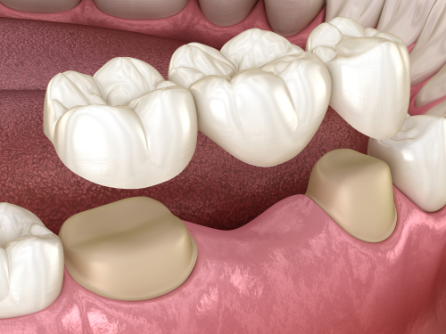 Teeth Bridges in Gulfport, MS | Book a Consultation